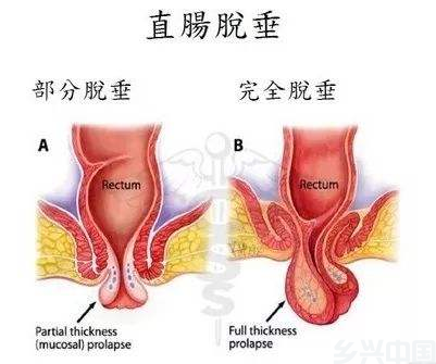 重度直肠脱垂！滨州市人民医院新技术为患者带来新生(图2)